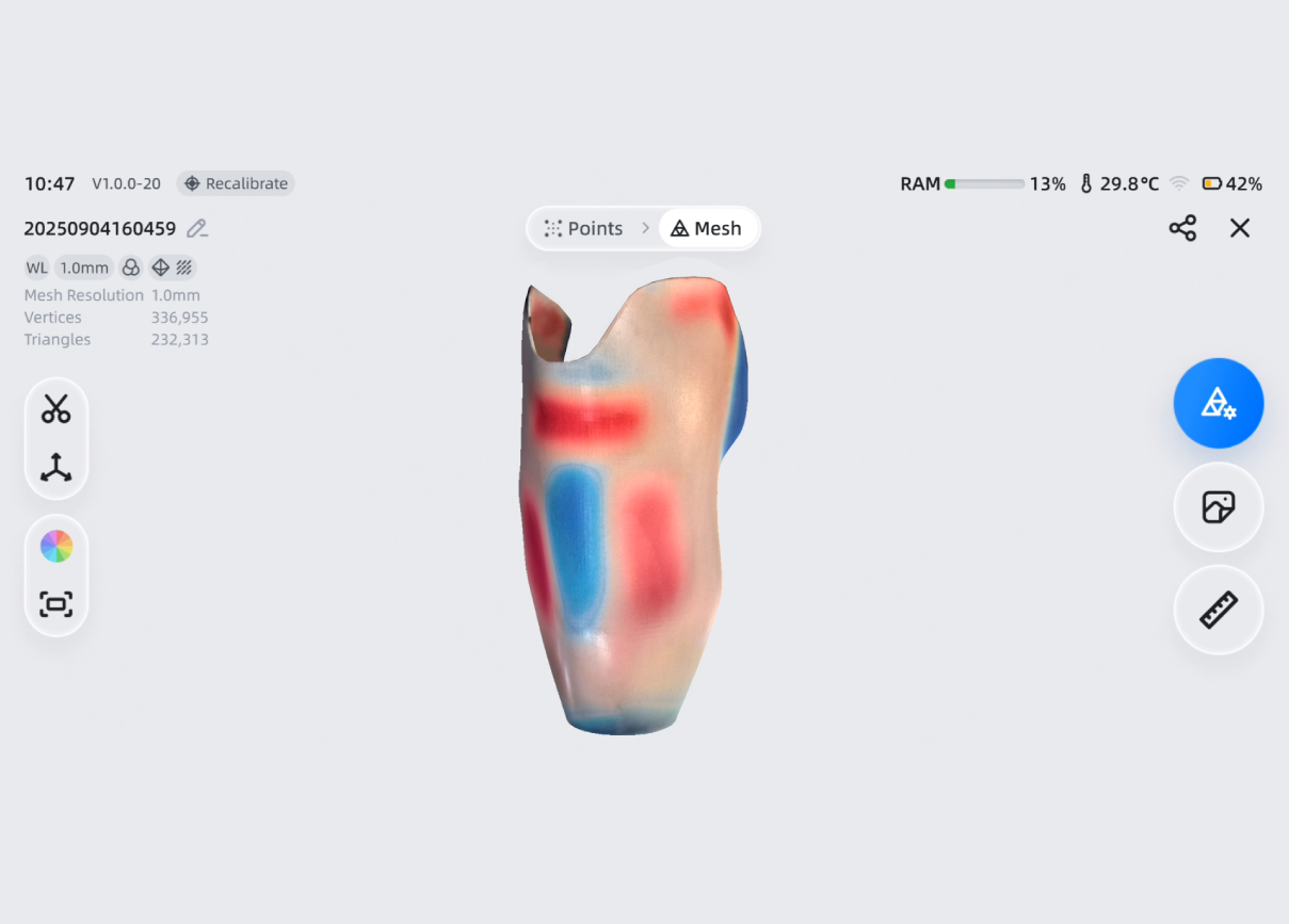 A 3D model of a prosthetic socket with red and blue clinical markings is shown on the EinScan Medixa interface.
